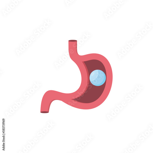 Intragastric Balloon. Gastric Balloon Inside a Stomach