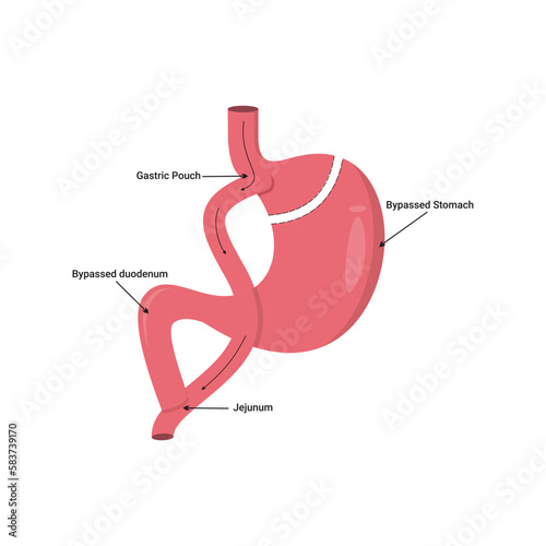 Gastric bypass surgery. Vector illustration.