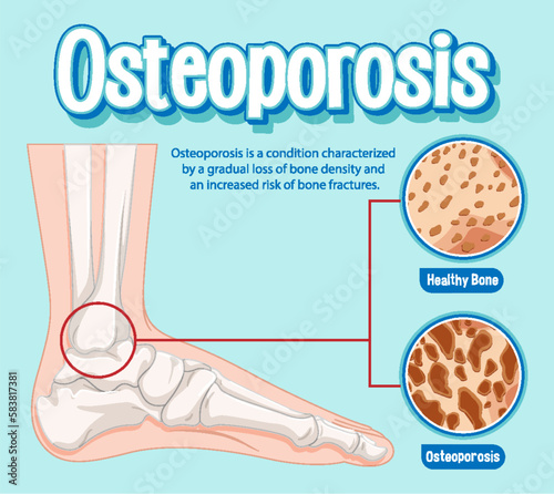 Informative poster of Osteoporosis human bone