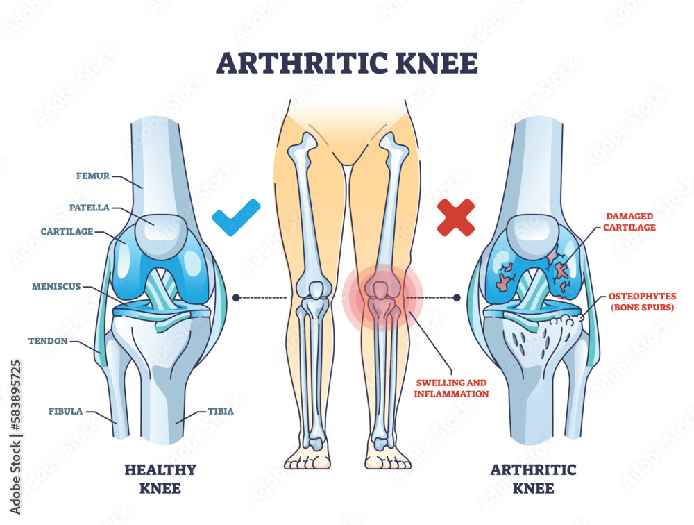 Arthritic knee or osteoarthritis and healthy bones comparison outline diagram. Labeled educational scheme with damaged cartilage and bone spurs diagnosis vector illustration. Anatomical skeletal leg. - obrazy, fototapety, plakaty 