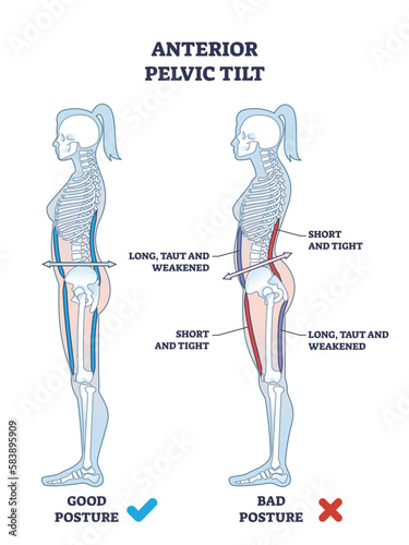 Anterior pelvic tilt or APT as pelvis abnormal posture outline diagram. Labeled educational scheme with syndrome from increased lordosis of lumbar spine and protrusion of abdomen vector illustration. photo