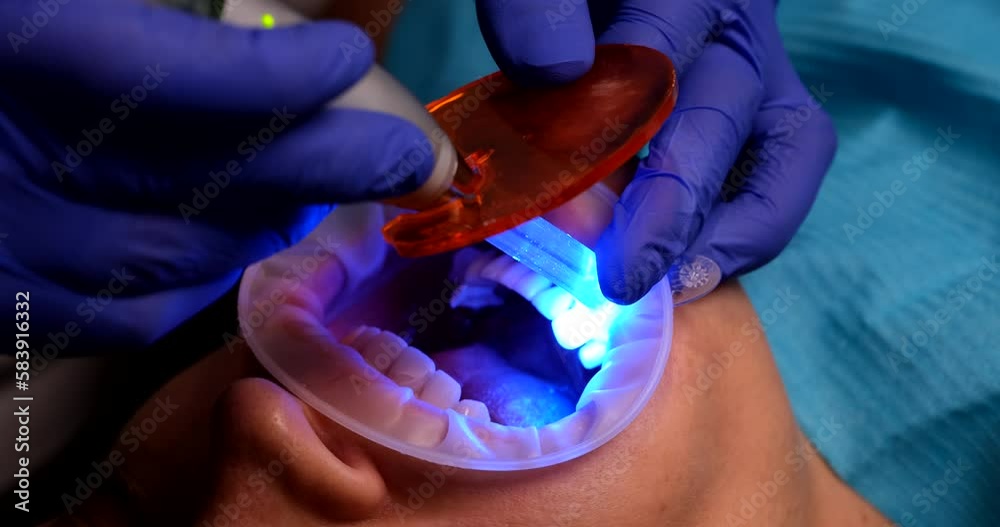 Doctor dentist illuminating filling on patient tooth using ultraviolet led machine closeup 4k movie slow motion