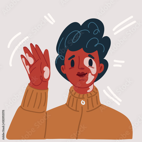 Vector illustration of dark-skinned girl with a violation of skin pigmentation, vitiligo. A beautiful girl loves her body
