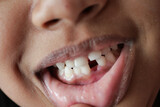 detail shot of child with teeth missing