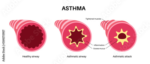 Asthma lung disease
