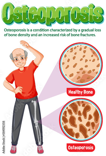 Informative poster of Osteoporosis human bone