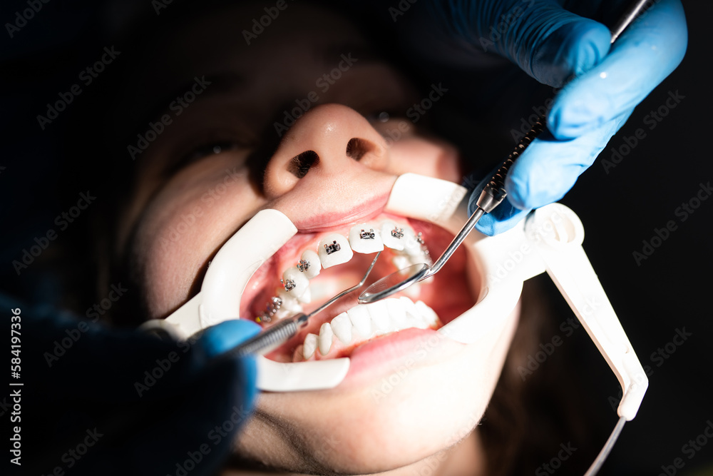 Close up of girl with brackets receiving dental braces treatment in clinic