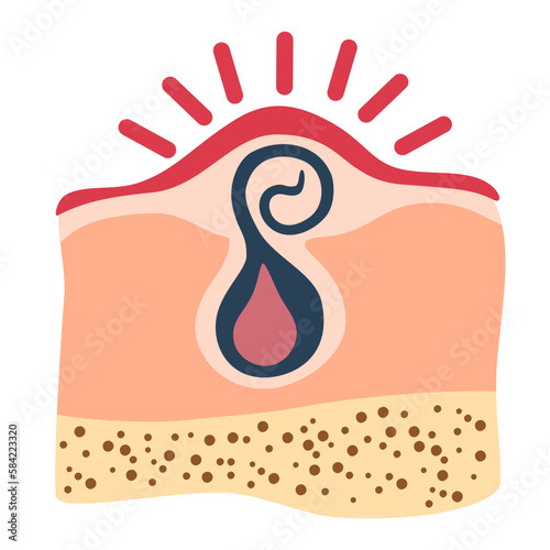 Ingrown hair. Inflammation, skin problems. Anatomy infographics of hair. Vector illustration isolated on the white background.