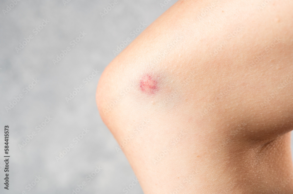 big bruise on the girl's skin close up. Skin hematoma. Purple wound. Skin injury. Skin trauma. big bruise on the girl's skin close up. Skin hematoma. Purple wound. Skin injury. Skin trauma.