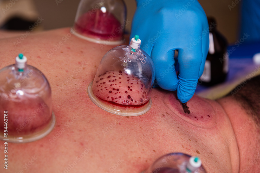 Fototapeta premium The doctor practices therapeutic massage, vacuum massage and hijama
