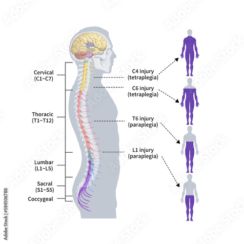 척수손상 마비부위 메디컬일러스트