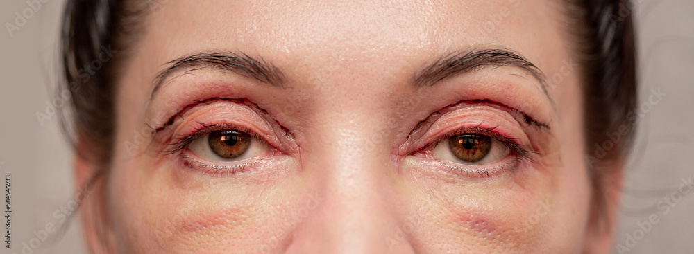 Plastic surgery of the face, skin tightening around the eyes. Surgical procedure to strengthen the skin of the eyelids, remove fatty hernias in the eyes. Operational blepharoplasty. Plastic surgery of the face, skin tightening around the eyes. Surgical procedure to strengthen the skin of the eyelids, remove fatty hernias in the eyes. Operational blepharoplasty.