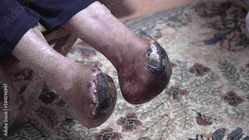 Flash necrosis after wound after leg amputation