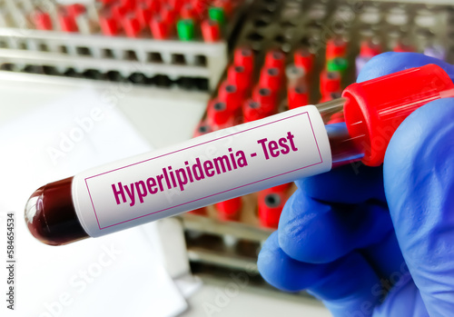Blood sample for Hyperlipidemia, Dyslipidemia . Lipid profile. Hypercholesterolemia photo