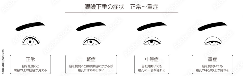 医療イラスト、眼瞼下垂の症状 正常~重症 医療イラスト、眼瞼下垂の症状 正常~重症