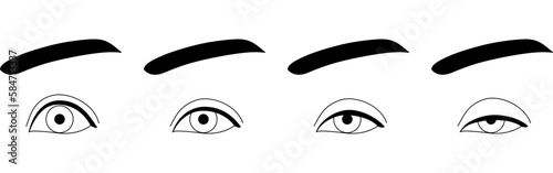 医療イラスト、眼瞼下垂の症状　正常～重症