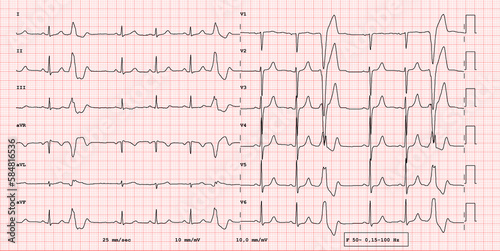 ECG example of 12-lead rhythm,  Wide QRS supraventricular extrasystole, real exam photo