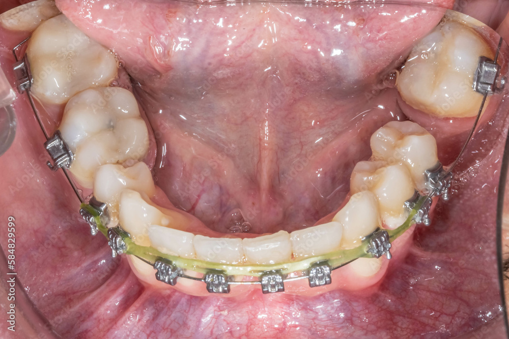 Dental orthodontics patient. Mirror indirect occlusal view of the ...