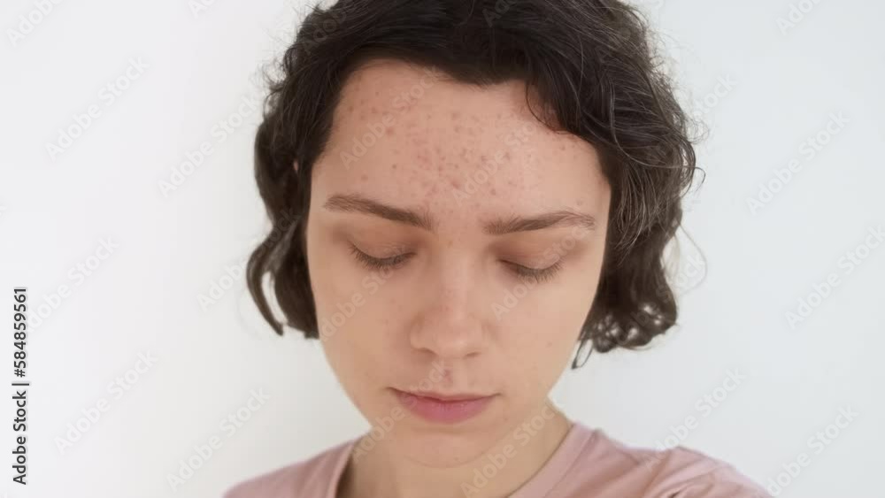 Young beautiful woman with problematic skin looks at camera like in mirror. Sad girl is shy about acne on face and tries to smile. Stages of acne treatment. Skin with acne scars before salon treatment Young beautiful woman with problematic skin looks at camera like in mirror. Sad girl is shy about acne on face and tries to smile. Stages of acne treatment. Skin with acne scars before salon treatment