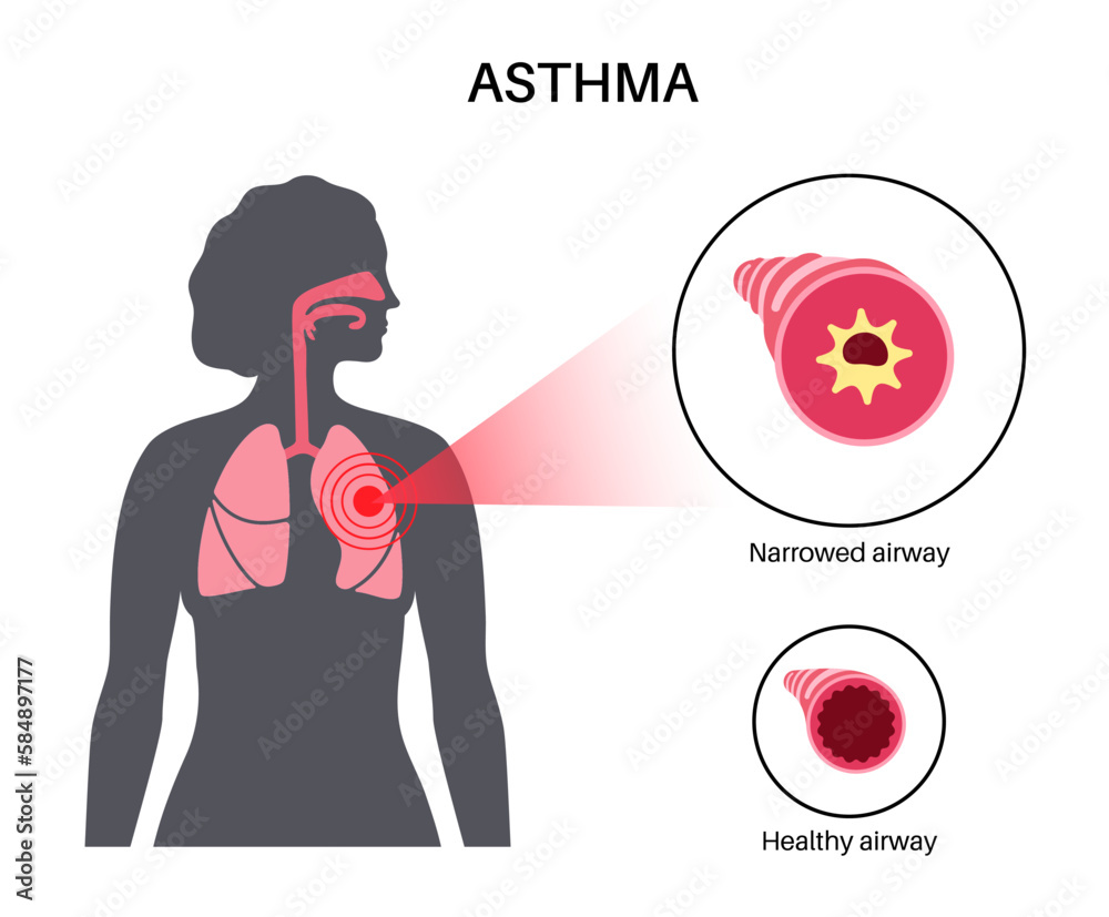 Asthma lung disease - obrazy, fototapety, plakaty 