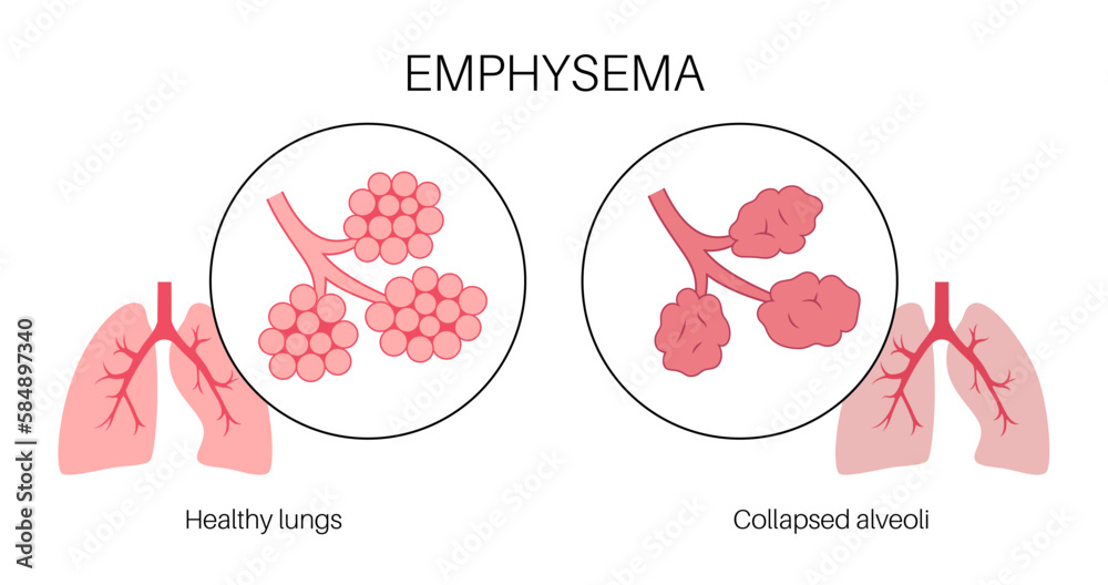 Emphysema anatomical poster - obrazy, fototapety, plakaty 