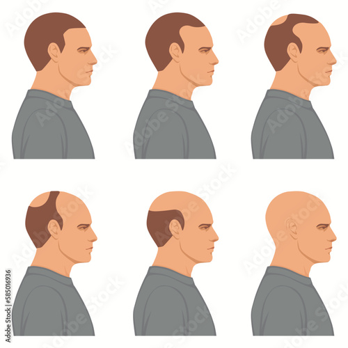 Hair loss stages vector isolated. Male alopecia. Set of balding process. Hairless man heads side view.