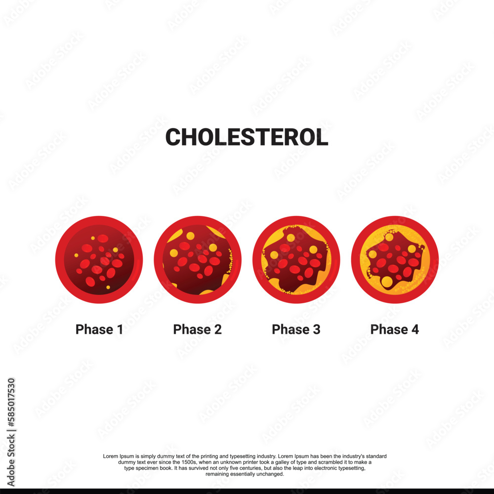Vecteur Stock Coronary artery disease is the buildup of plaque in the