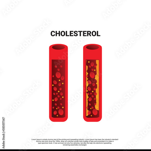 Coronary artery disease is the buildup of plaque in the arteries that supply oxygen-rich blood to your heart. Plaque causes a narrowing or blockage that could result in a heart attack