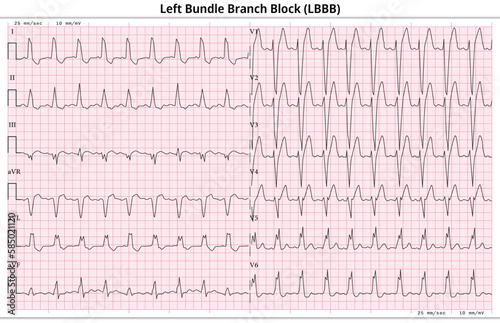 ECG LBBB (Left Bundle Branch Block) - 12 Lead ECG Common Case - 6 Sec/lead - Vector Illustration