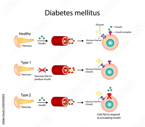 Diabetes mellitus type 1, pancreas's failure to produce enough insulin and type 2, cells fail to respond to insulin (Insulin resistance). Result in high blood glucose levels. Vector illustration photo