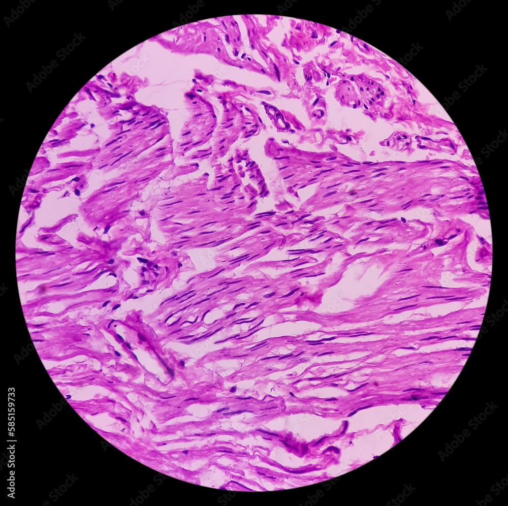 Chronic anal fissure with fistula (histology): Fistulous tract. show ...