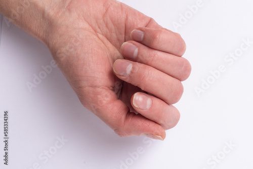 Close-up of female age-related hands with natural broken unhealthy diseased nails, overgrown cuticle