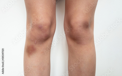 Bruises and scars on the knees of a 10 year old boy.