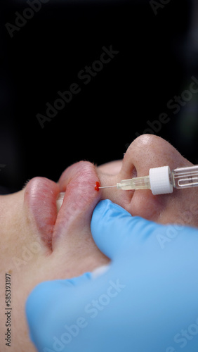 Surgeon, in medical gloves, carefully and slowly injects hyaluronic acid into woman's lips with a syringe. © skywayua