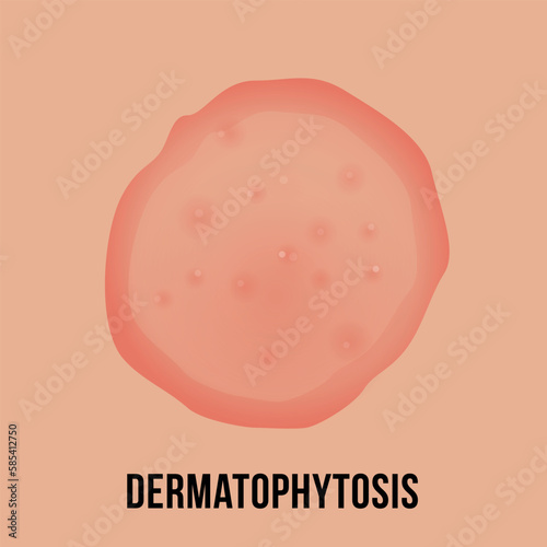 Dermatophytosis skin with fungal infection medical infographic scheme vector flat illustration