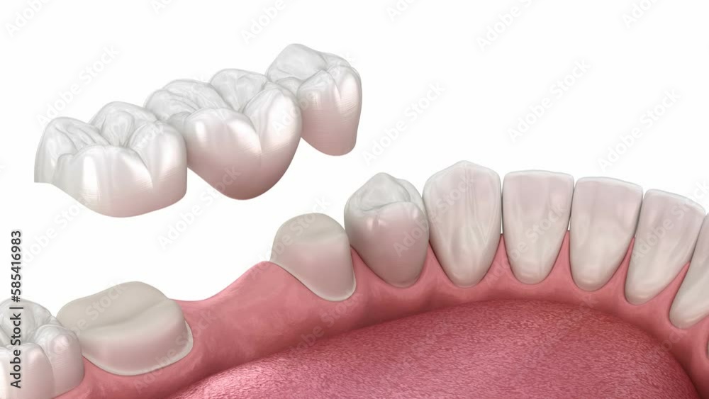 Dental bridge placement. 3D animation Dental bridge placement. 3D animation