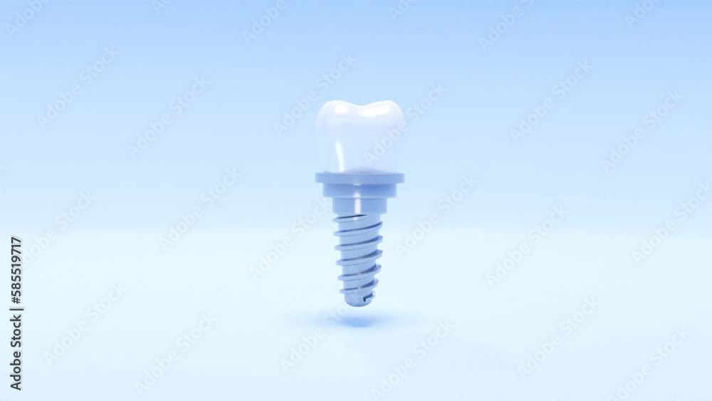 3d tooth implant animation. Isolated rotating 3d tooth implant model