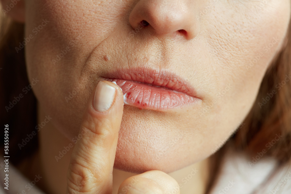 Fototapeta premium Female applying ointment using finger on beige