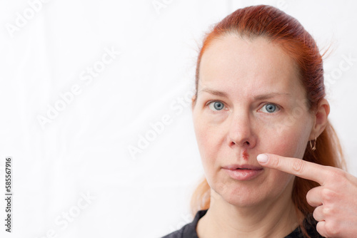 Herpes above upper lip in woman. portrait of middle aged woman with problem skin, on light background. woman pointing finger at infectious inflammation of face caused by herpes simplex virus. photo