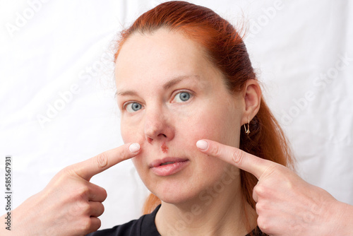 Herpes above upper lip in woman. portrait of middle aged woman with problem skin, on light background. woman pointing fingers at infectious inflammation of face caused by herpes simplex virus. photo