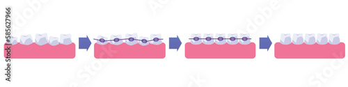 Process of teeth straightening with dental braces, flat vector illustration isolated on white background.