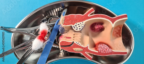 Εκτύπωση καμβά Surgical interventions for intestinal obstruction and resection of intestine