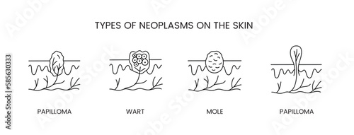 Types of neoplasms on the skin, line icon set in vector, papilloma and wart, mole and papilloma illustration.