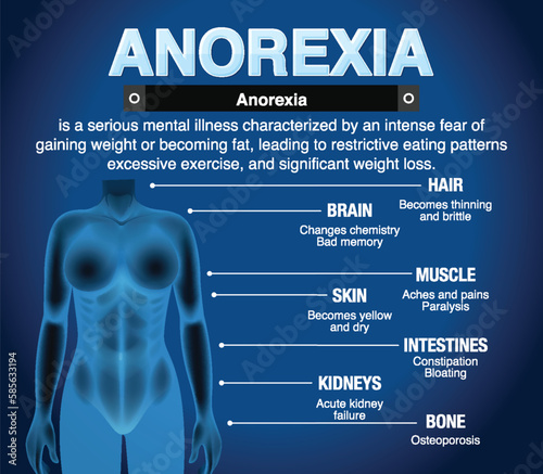 Informative poster of Anorexia eating disorder