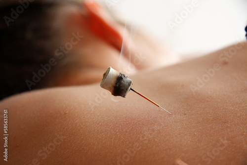 Acupuncture Session