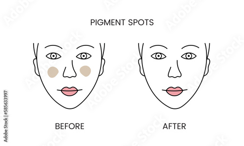 Pigment spots, laser cosmetology before procedure and after applying treatment line icon in vector. Illustration of a woman with smooth clean skin and problematic skin.