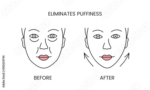 Eliminates puffiness, laser cosmetology before procedure and after applying treatment line icon in vector. Illustration of a woman with smooth clean skin and problematic skin.