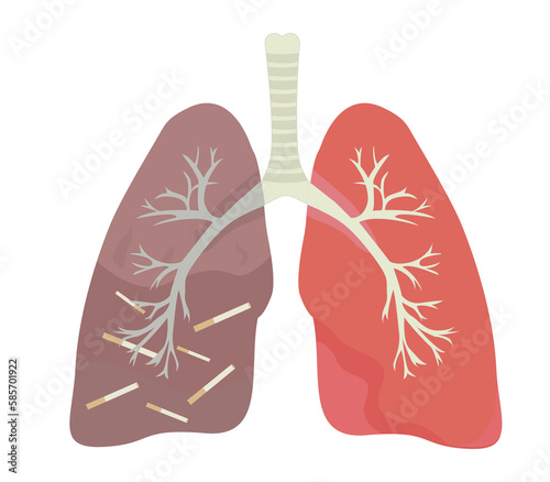 Healthy and sick human lungs with trachea illustration