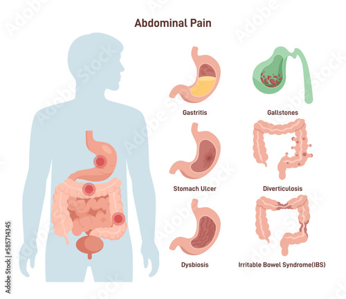 Abdominal ache. Medical infographic of different abdominal organ
