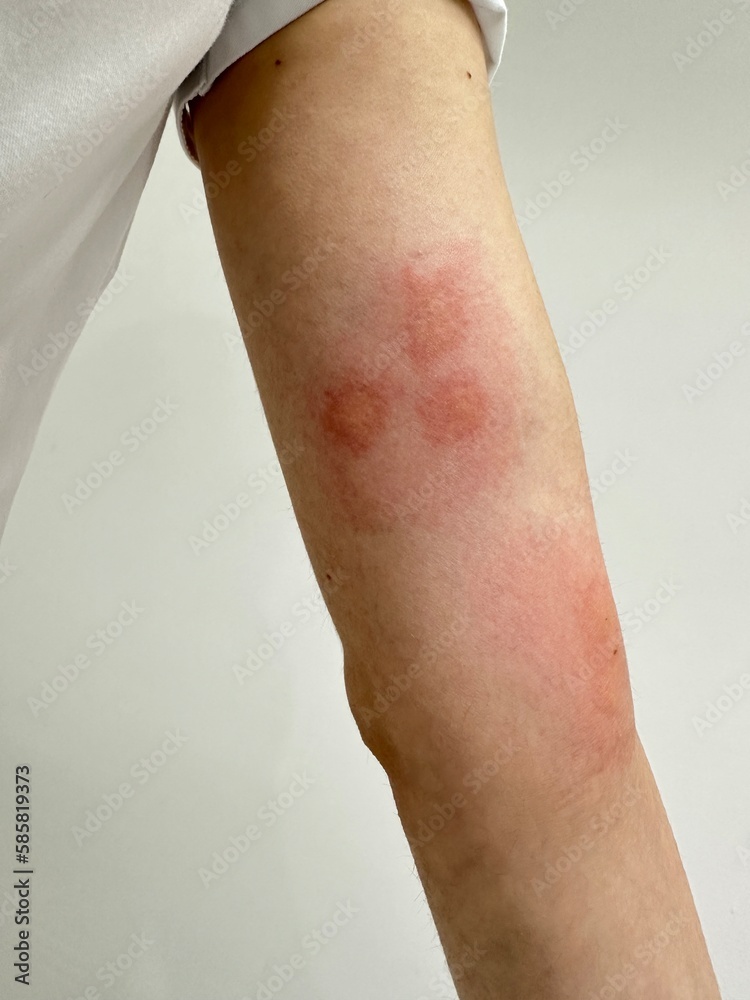 Fototapeta premium close up of a person with a bandage
